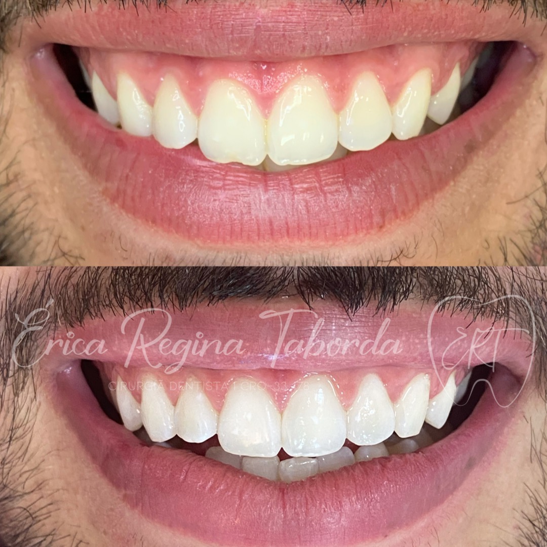 Reabilitação do sorriso
