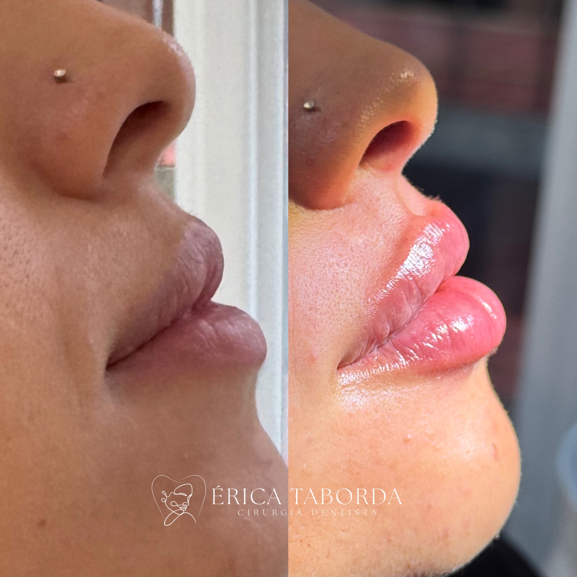 Preenchimento labial