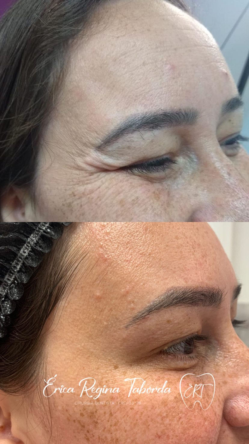 Botox região dos olhos