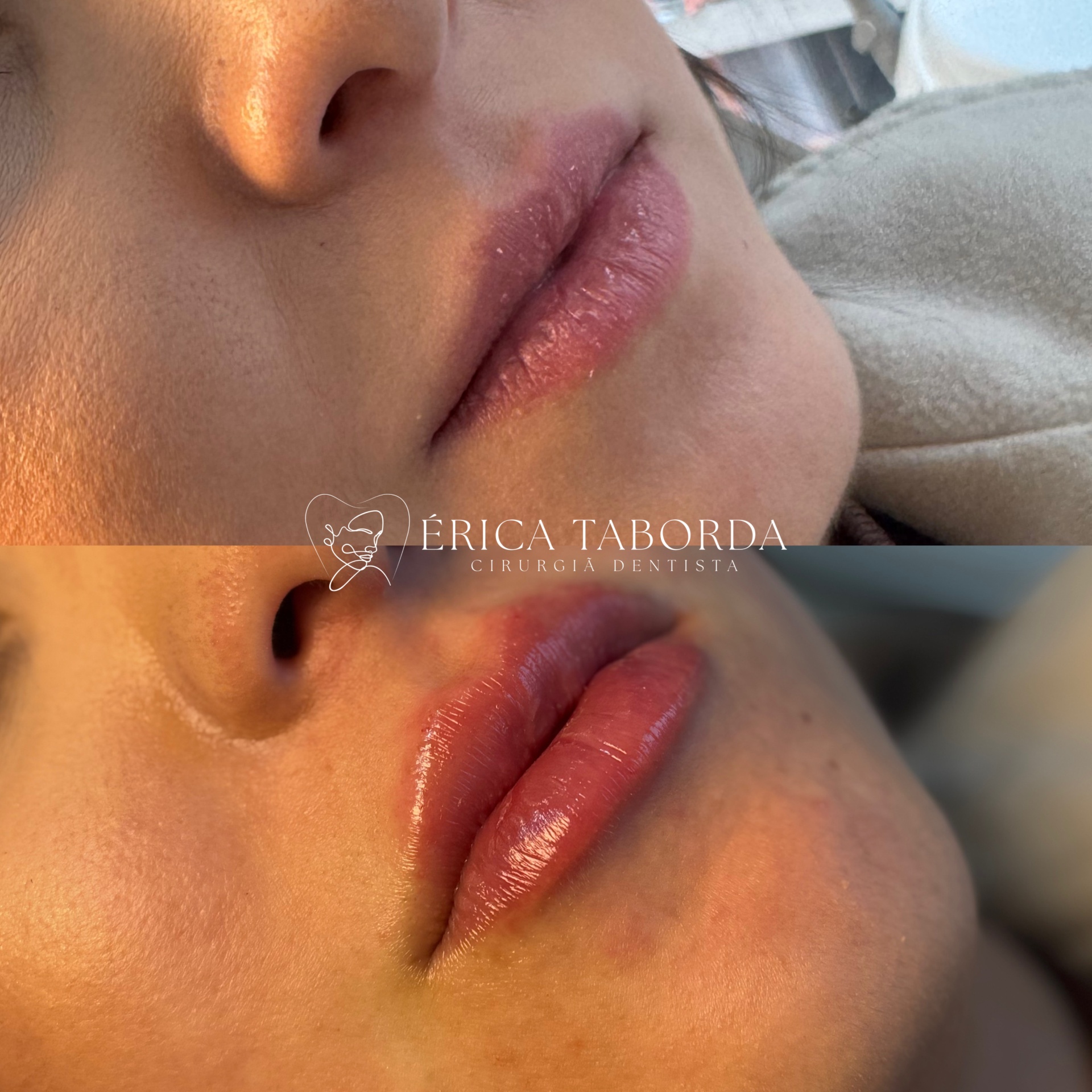 Preenchimento labial com contorno natural