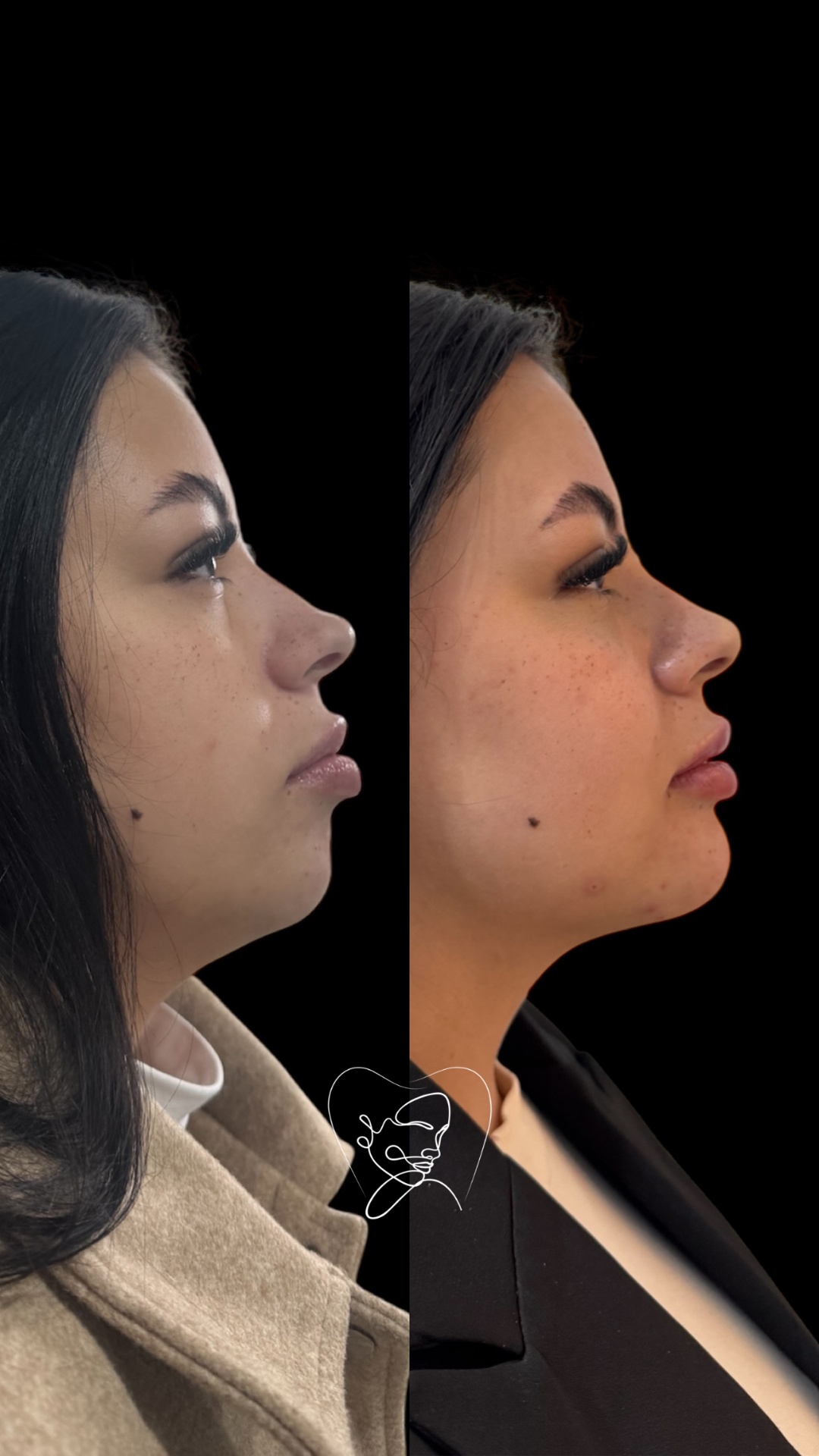 Perfiloplastia