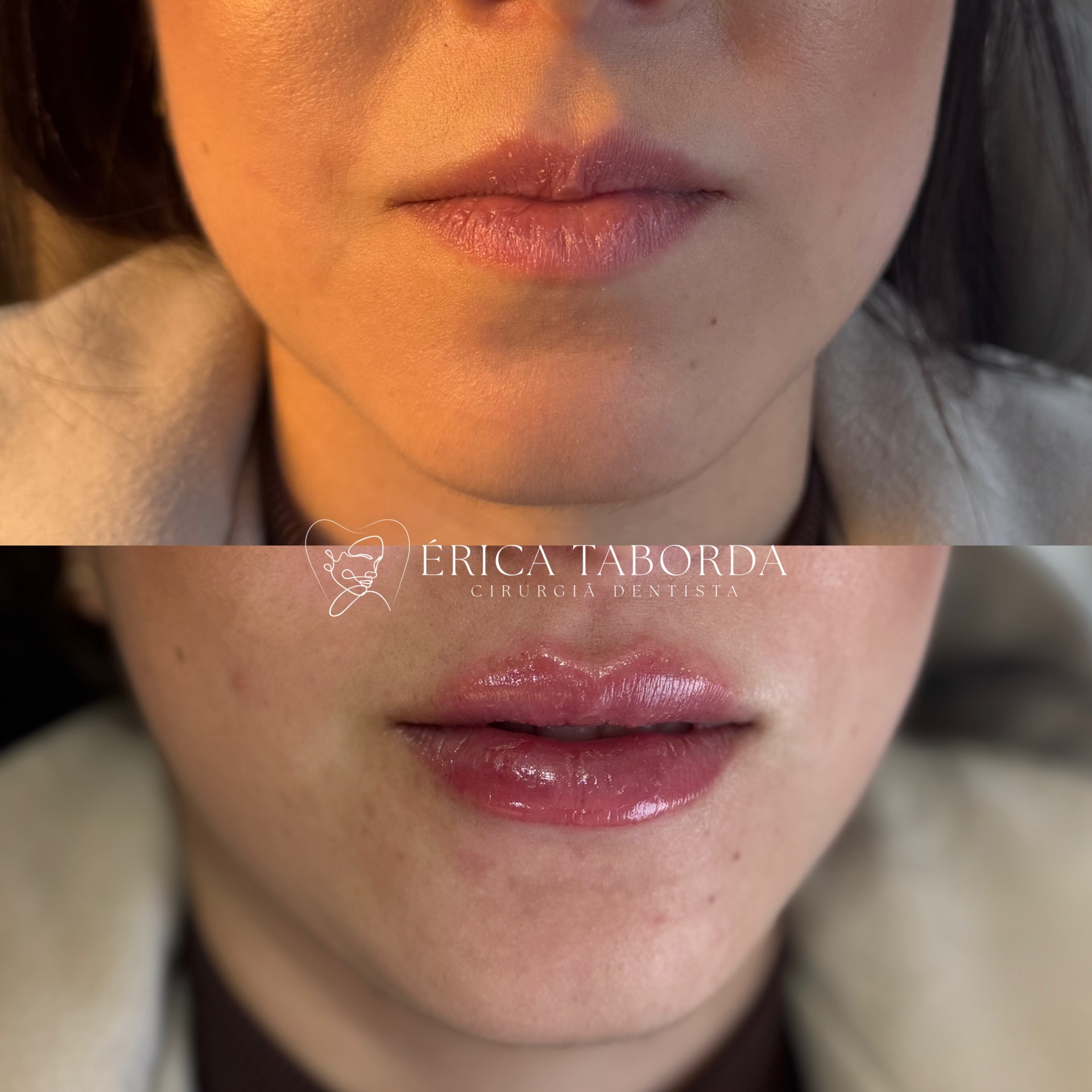 Preenchimento labial