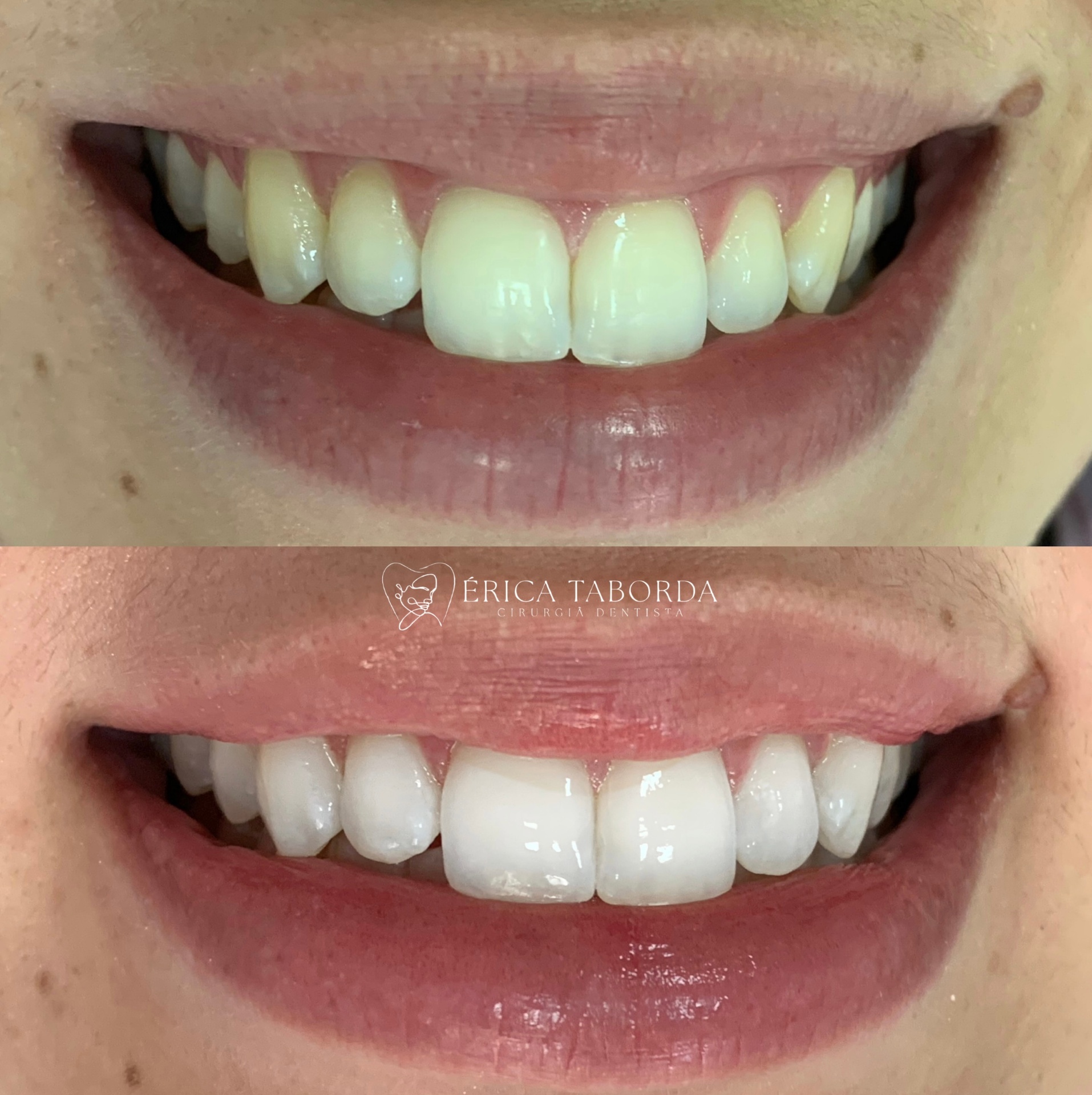 Resultado de estética dental