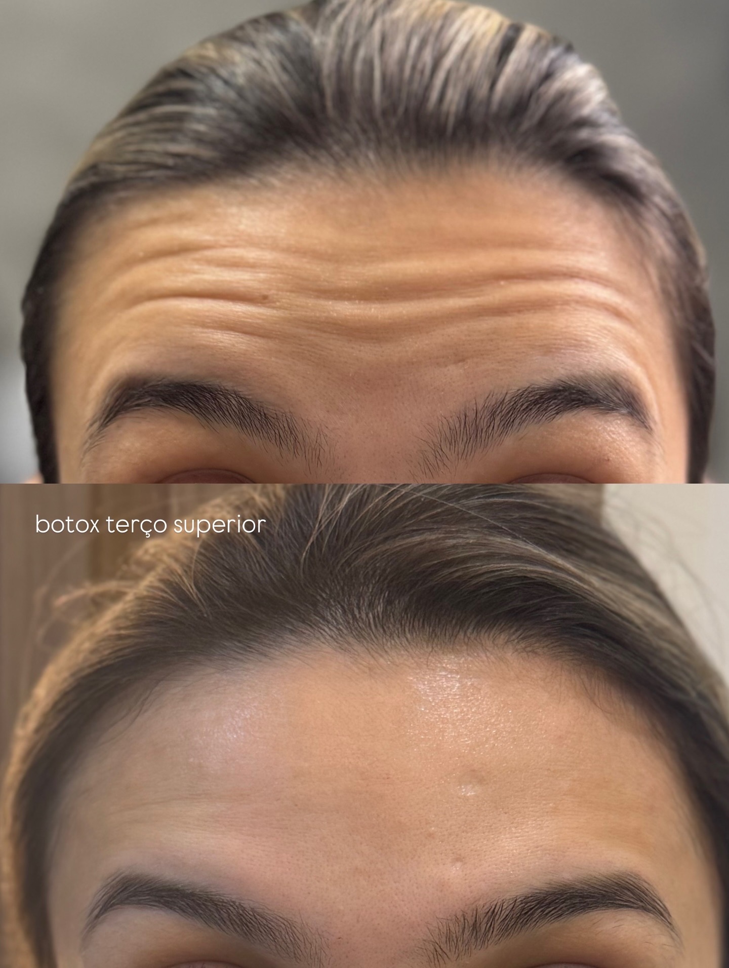 Botox terço superior
